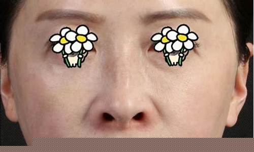打玻尿酸祛除法令纹