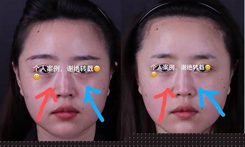 法令纹打玻尿酸后僵硬